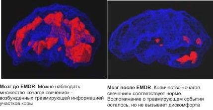 emdr.jpg